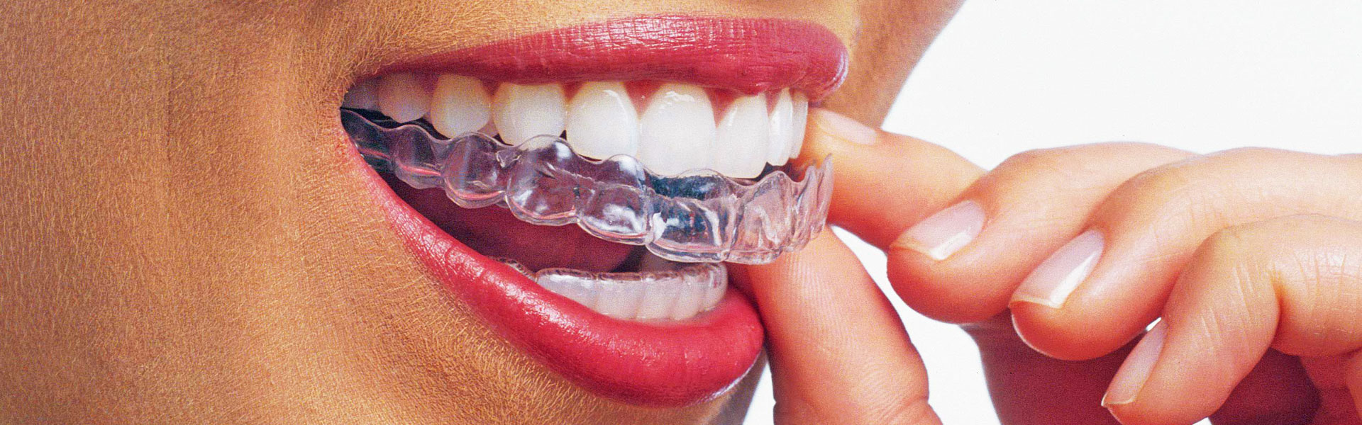 Invisalign