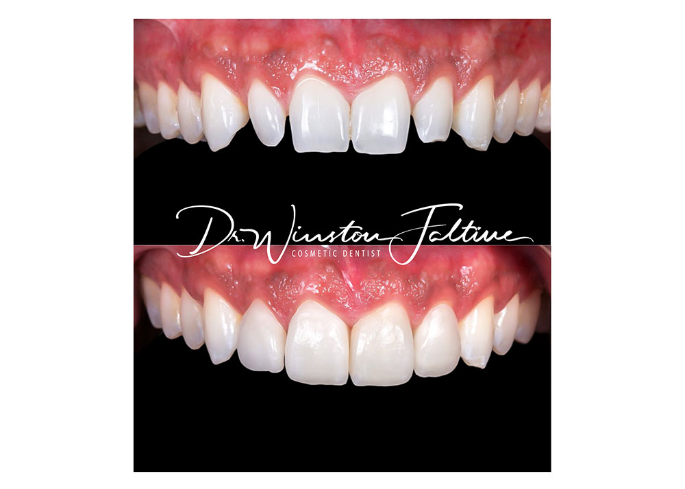 4 upper veneers
