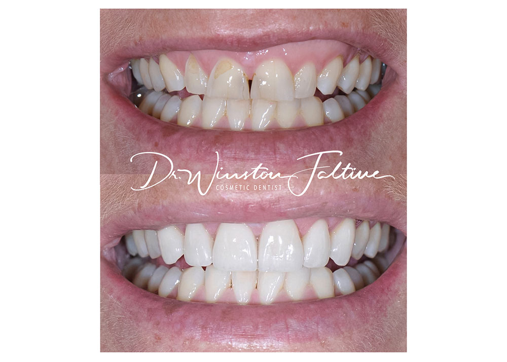6 upper veneers