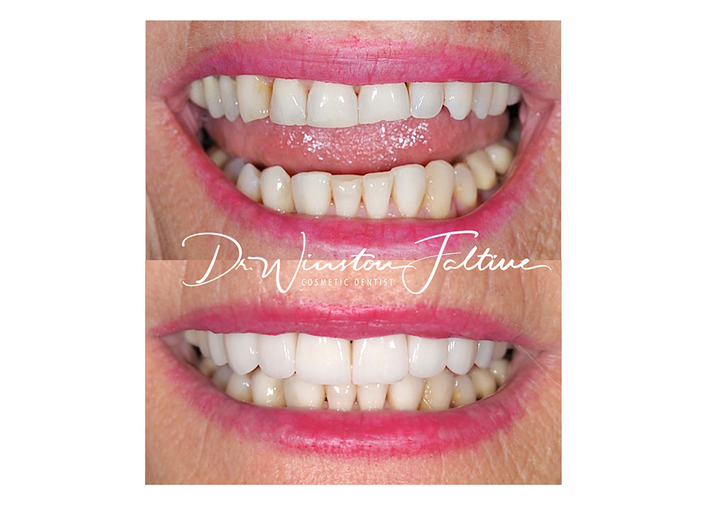 8 upper veneers