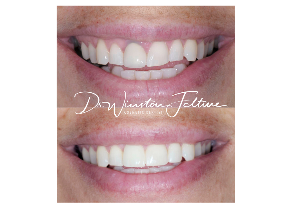 Anterior dental implant
