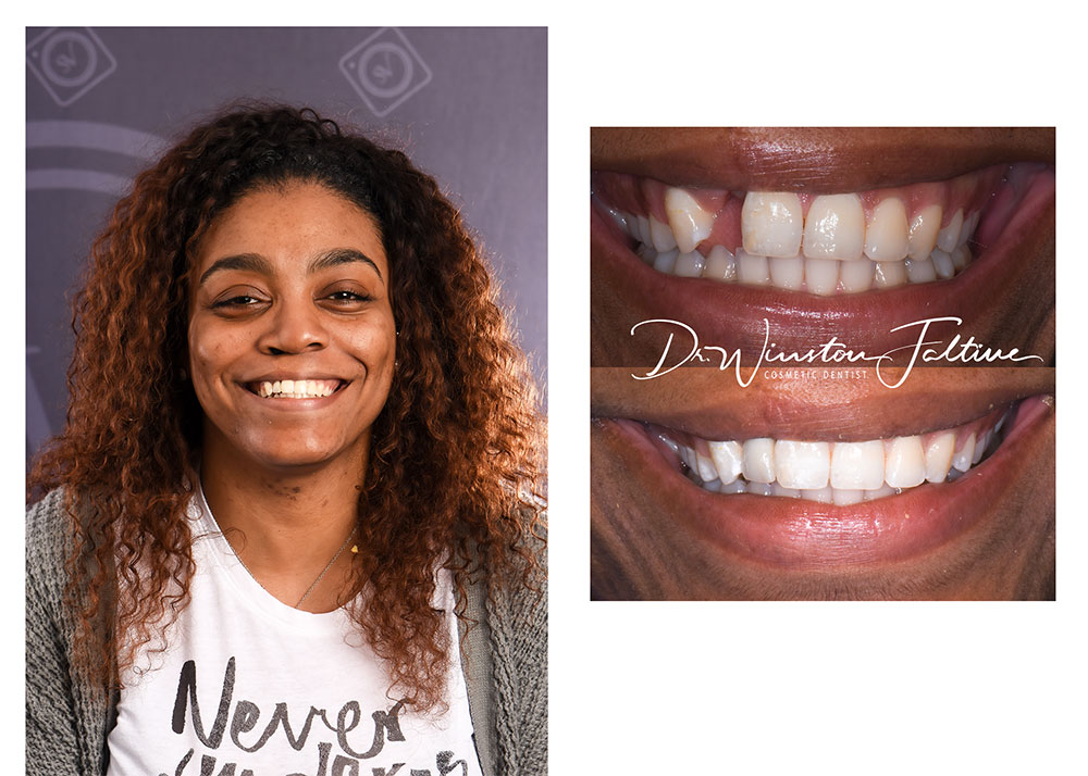 Replacing missing tooth wth porcelain crown
