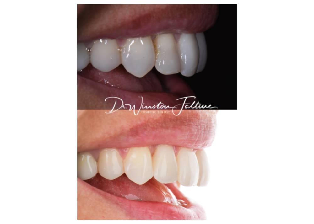 Upper-veneer-case-new-1