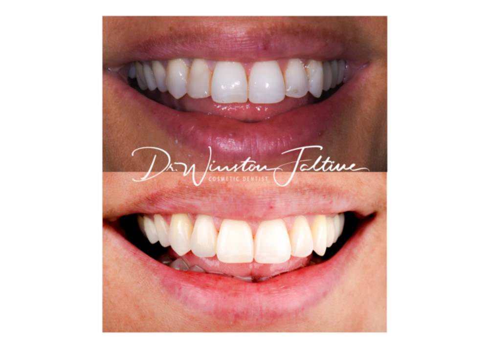 Upper-veneer-case-new-2