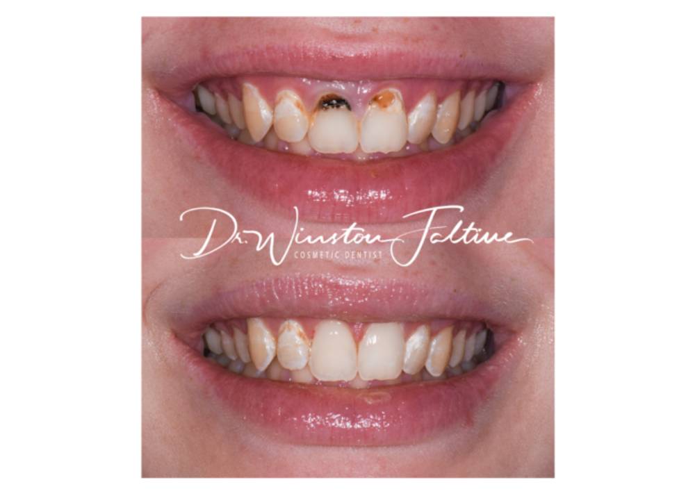 Upper-veneer-case-new