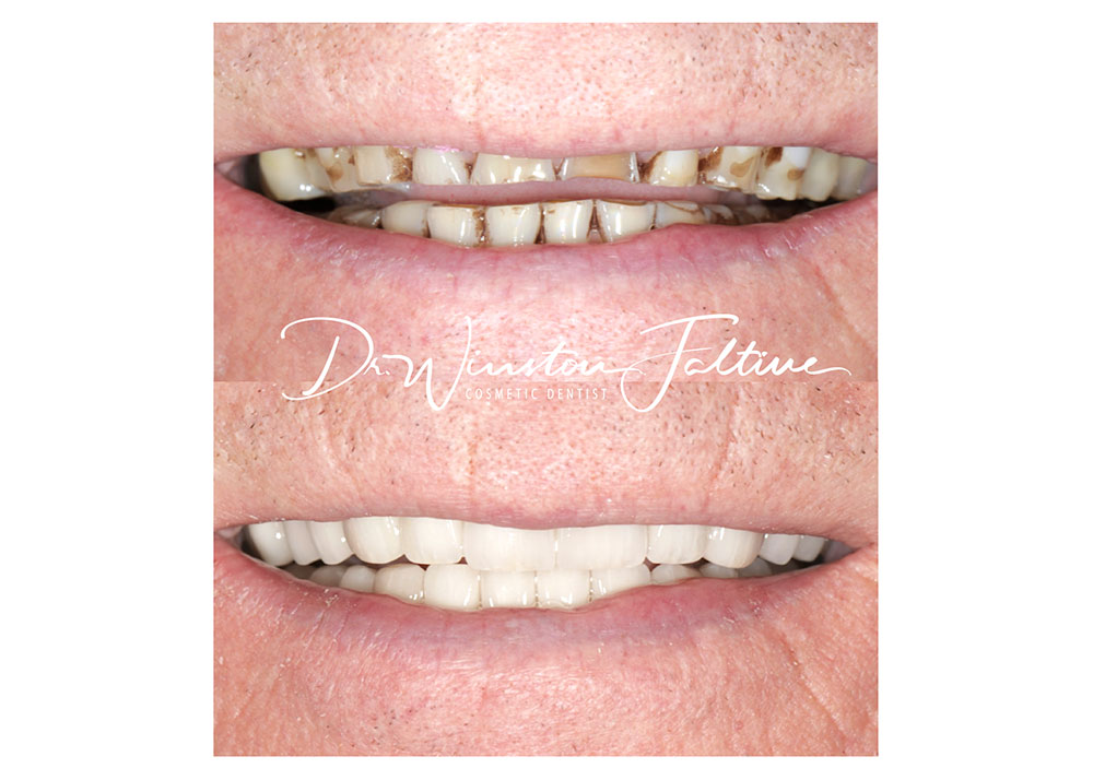 Full mouth rehabilitation