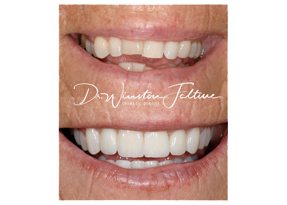 Upper and Lower veneers